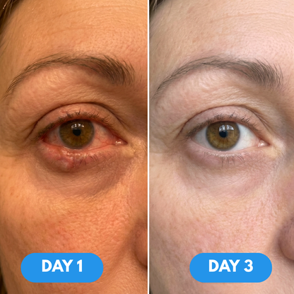Vireo® Eye Steam Therapy